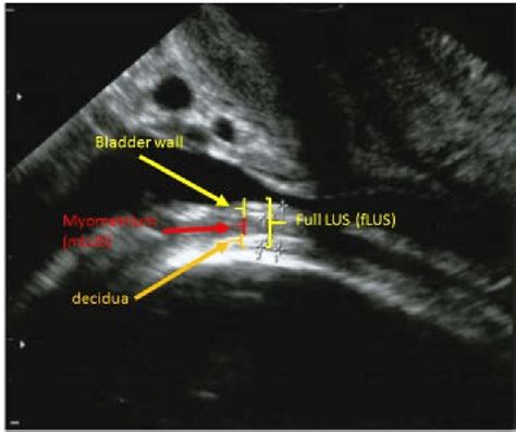 measurement of lower uterine segment thickness|sonographic lower uterus segment thickness.